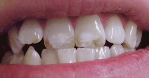 Kenapa Gigi Saya Tidak Putih – Arilglow  Teeth Whitening