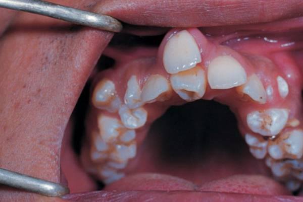 BLOGS – Arilglow  Teeth Whitening